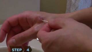 How to Treat Blisters [upl. by Allebasi]