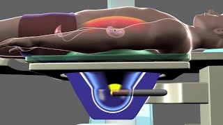 Shockwave Lithotripsy [upl. by Egiap]