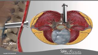 Lumbar Microdiscectomy  Spine Center Northern Nevada Northern California  Spine Surgery [upl. by Tia]