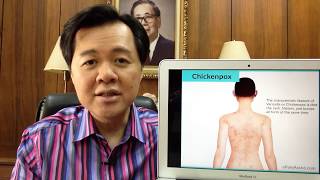 Chicken Pox o Bulutong Tubig  Payo ni Dr Willie Ong 100 [upl. by Ecinhoj]