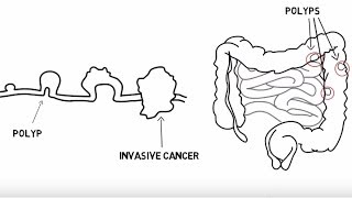 The Story of My Colorectal Cancer Diagnosis [upl. by Elidad]