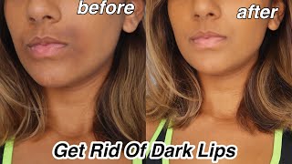 How To Get rid Of Dark Lips And Pigmentation [upl. by Koren]