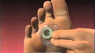 Dr Scholls Commercial 1996 Callus Removers Cushlin Advanced Pain Relief [upl. by Tennies523]