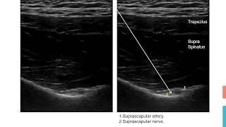 Suprascapular nerve block [upl. by Ailliw166]