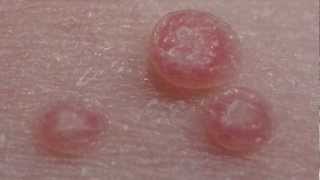 How to treat Molluscum Contagiosum [upl. by Niawd]