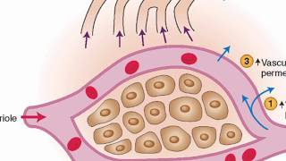 Mechanisms of edema development [upl. by Trutko]