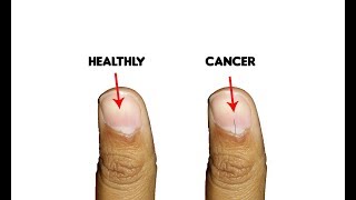 9 Fingernails serious alarming health issues and probllems [upl. by Tilly]