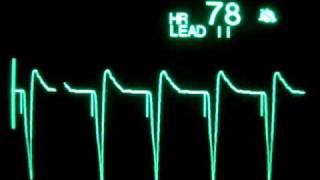 Ventricular Pacing [upl. by Enasus]