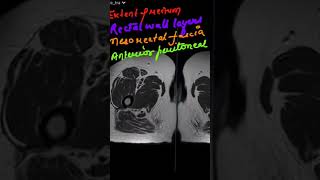 Carcinoma rectum MRI RADIOLOGY  Anatomy [upl. by Naul911]