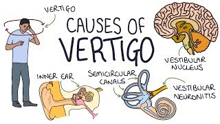 Understanding the Causes of Vertigo [upl. by Dallon]