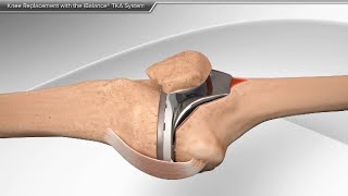 Knee Replacement with the iBalance TKA System [upl. by Hazeghi355]