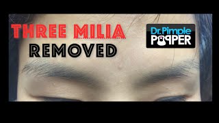 Three milia extracted on the face [upl. by Siclari]