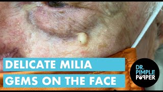 Delicate Milia Gems on the Face [upl. by Stesha]