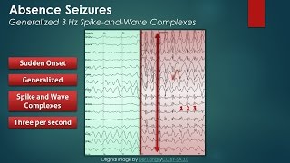 Absence Seizures EEG Findings [upl. by Bryce38]