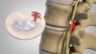 Herniated Disc  Patient Education [upl. by Airdna907]