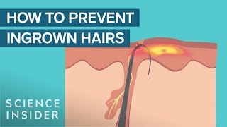 What Are Ingrown Hairs — And How To Treat Them [upl. by Wadlinger319]