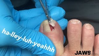 REMOVING A LARGE INGROWN TOENAIL [upl. by Miharbi]