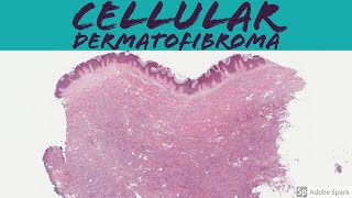 Cellular Dermatofibroma Cellular Fibrous Histiocytoma 5Minute Pathology Pearls [upl. by Sanders]