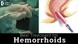 Laser Hemorrhoidoplasty vs Open Hemorrhoidectomy  Hemorrhoid Treatment  Dr Rajasekhar M R [upl. by Asilav]