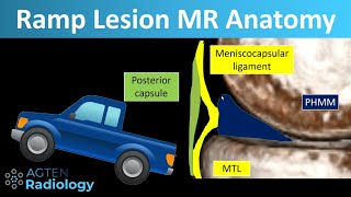 Ramp Lesions on Knee MRI Anatomy [upl. by Nudd]