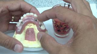 Overdenture Abutment Part 1 [upl. by Zebadiah106]