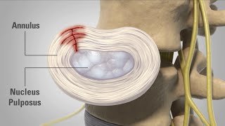 Patient Animation  Lumbar Degenerative Disc Disease [upl. by Gellman954]