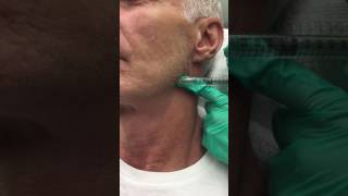 Juvederm Voluma Filler for the Jawline [upl. by Brazee]