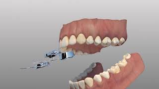 Rapid Palatal Expander [upl. by Tandy]