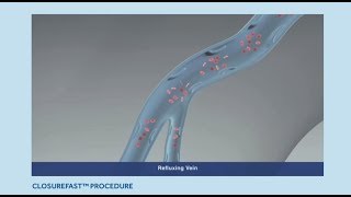 Varicose Veins Treatment ClosureFast Procedure Animation [upl. by Assirialc]