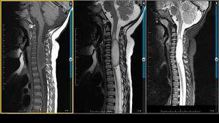 Cervical Spinal Cord Astrocytoma on MRI [upl. by Nemracledairam]