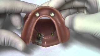 Implant Overdenture  Model Demonstration [upl. by Notsuj599]