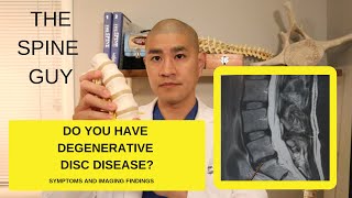 Lumbar Degenerative Disc Disease Part 1 Symptoms and Imaging [upl. by Eednahs262]