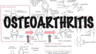 Osteoarthritis OA  Pathophysiology  Rheumatology Series [upl. by Eelrehpotsirhc]