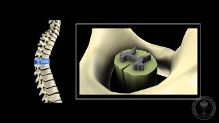 An Introduction to Cerebrospinal Fluid CSF Leaks [upl. by Nenney]