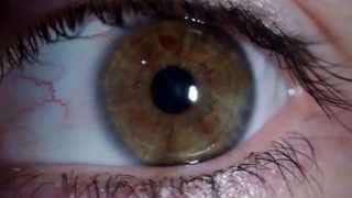 Nistagmus rotatorio  Rotary Nystagmus [upl. by Yelrebma]