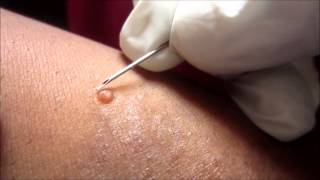 Removing H P Body From Molluscum Contagiosum [upl. by Netsew457]