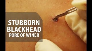 Stubborn Blackhead Removal  Dr Derm [upl. by Morette]