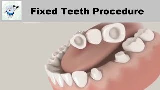 Dental Bridge Procedure  Fixed Teeth [upl. by Leikeze]