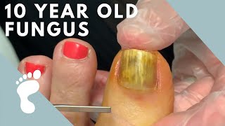 Fungus Takes Over Toenail  Toenail Removal [upl. by Yngiram]