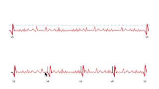 Pacemakers and quotslowquot AF patients [upl. by Htnamas178]