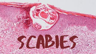 What is Scabies  Pathology mini tutorial [upl. by Nnylecoj149]