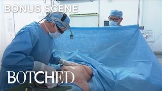 quotBotchedquot Doc Performs Liposuction Surgery  E [upl. by Neitsirk240]