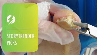 Podiatrist Treats Oozing Infected Toenail [upl. by Renat]