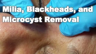 Milia Blackheads and Microcyst Removal [upl. by Romito]