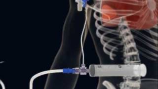 How to make a Thoracentesis pleural puncture with Pleurasafe  short 3D animationflv [upl. by Rolat51]