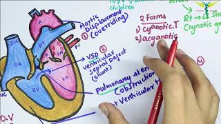 Mayo Clinic – Tetralogy of Fallot [upl. by Auqinat]