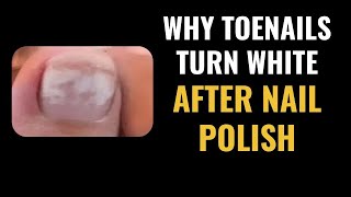 WHITE Toenails after Nail Polish  QUICK TREATMENT FROM PODIATRIST [upl. by Nitza]