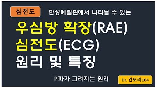 우심방 확장Right atrial enlargement 심전도ECG 원리 및 특징 이해 [upl. by Aninat719]