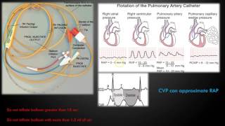 Hypertensive Retinopathy Fundoscopy [upl. by Ignatia396]