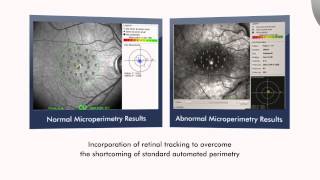 Visual field changes in glaucoma [upl. by Sandy]